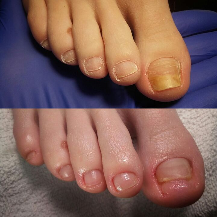 Before and after applying Exodermin cream from Yesenia