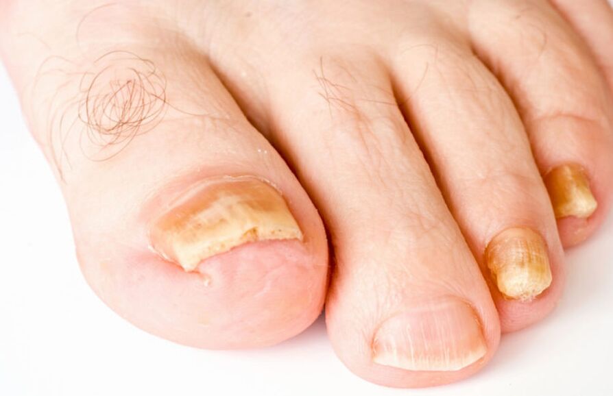 symptoms of foot fungus