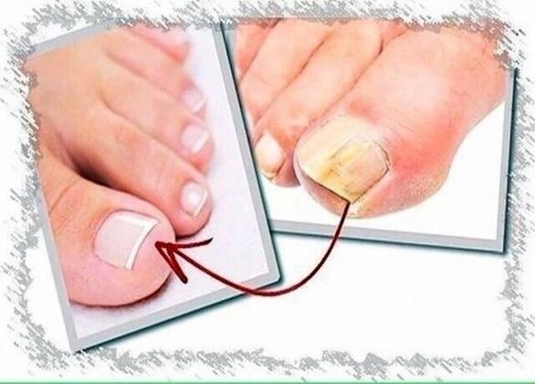 before and after nail fungus treatment