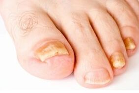 yellow toenails with fungus