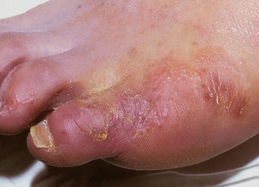An example of a fungal infection of the foot caused by Trichophyton interdigitale