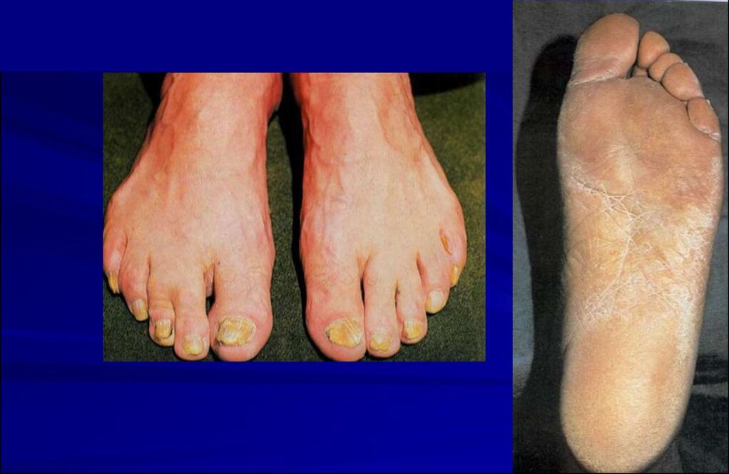 Squamous-hyperkeratotic form of fungi (foot rubromycosis)