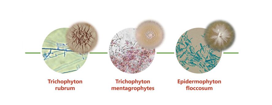 The main cause of skin fungus on the legs