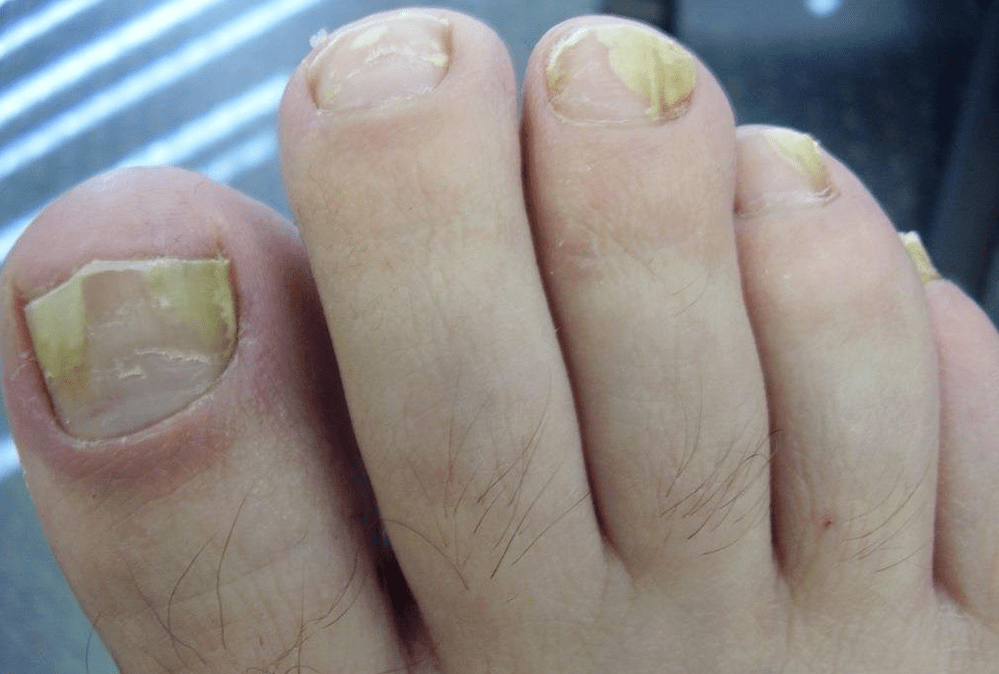 yellow nails due to fungal infection