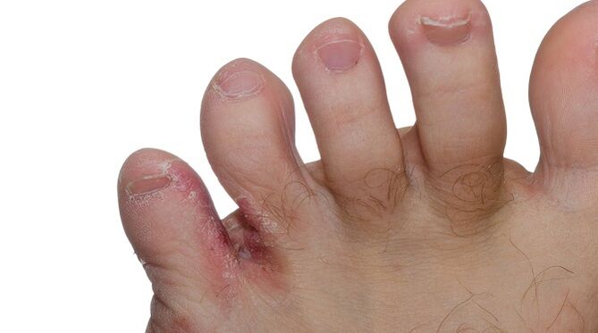 Signs of fungus between the toes - cracks and peeling of the skin