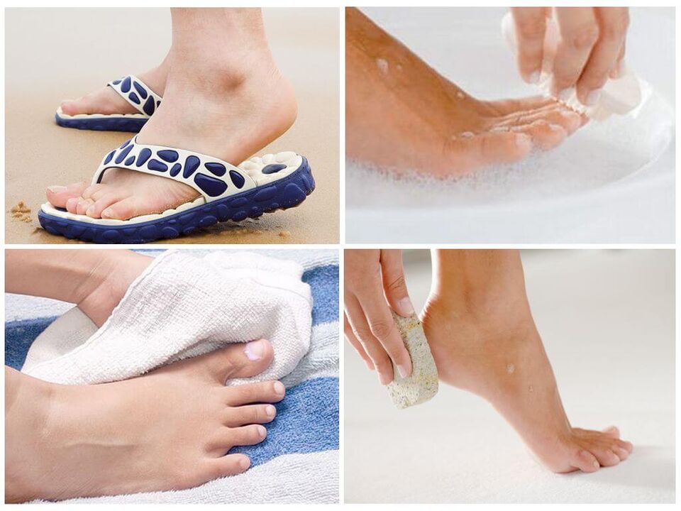 Prevention of onychomycosis includes foot hygiene, use of personal items and timely pedicure. 