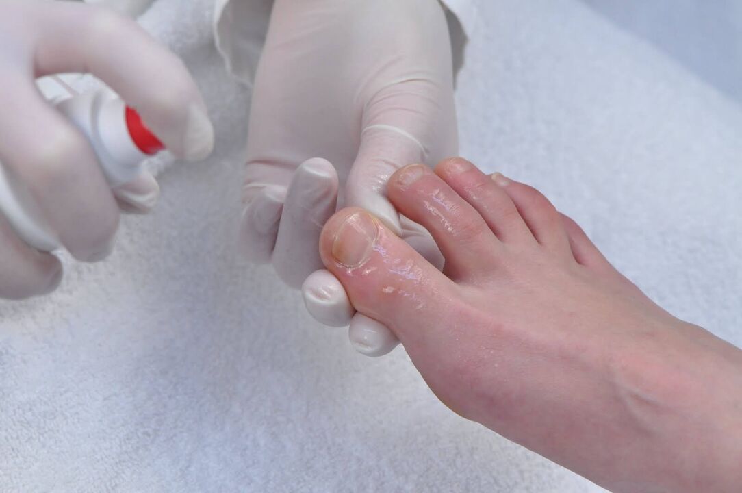 The initial stage of onychomycosis is a reason to undergo a diagnostic examination by a dermatologist