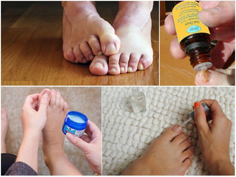 Treatment of toenail fungus with antifungal solutions, ointments and varnishes