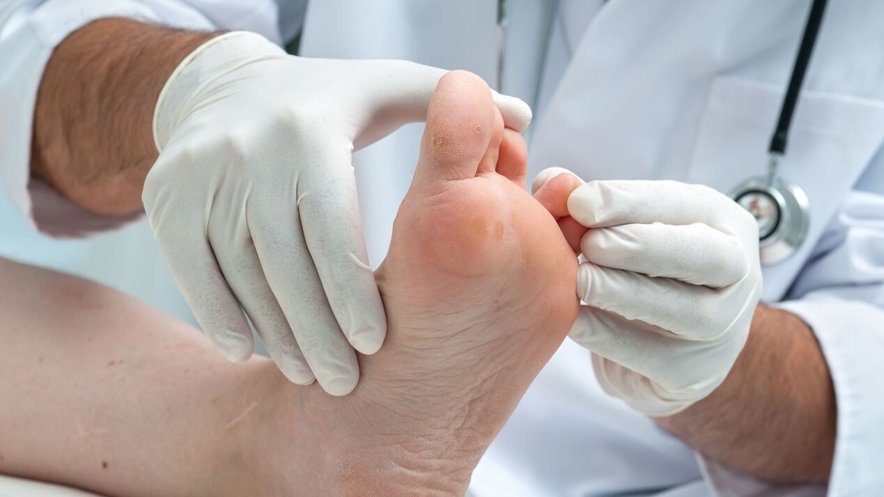 Diagnosis of athlete's foot