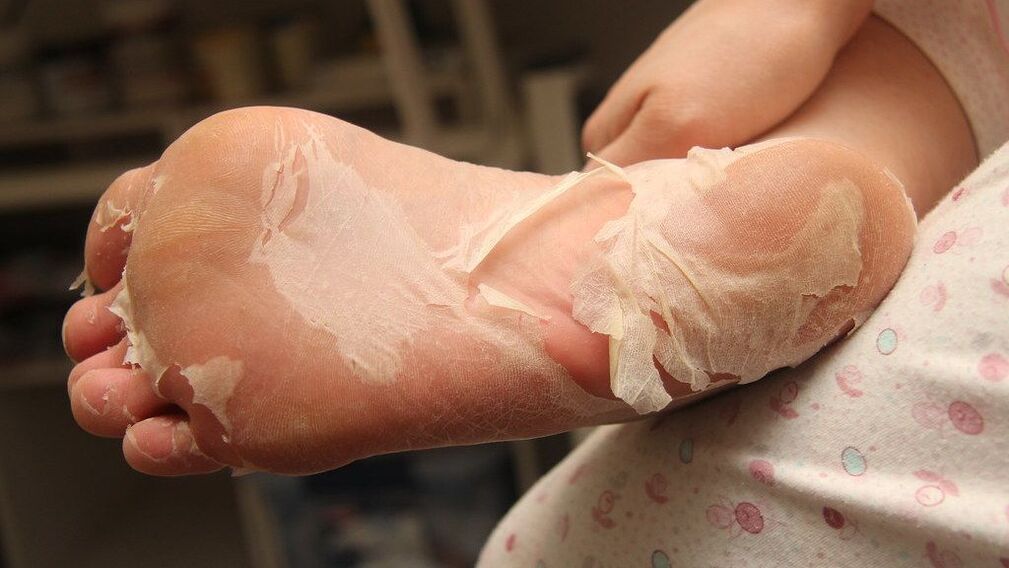 severe fungal infection of the foot